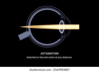 Astigmatism eye disease. Refractive error medical poster. Blurred vision problem at any distance. Visual distortion caused by uneven corneal or lens curvature. Human eye anatomical vector illustration