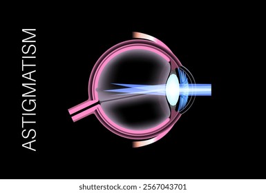 Astigmatism eye disease. Refractive error medical poster. Blurred vision problem at any distance. Visual distortion caused by uneven corneal or lens curvature. Human eye anatomical vector illustration