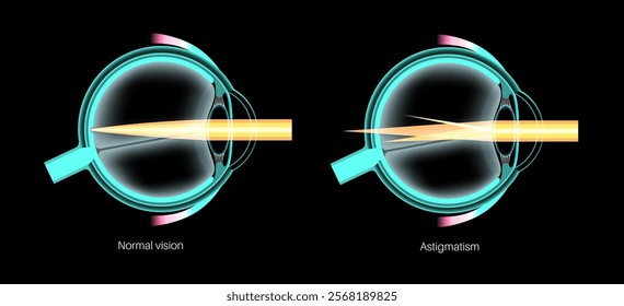 Astigmatism eye disease. Refractive error medical poster. Blurred vision problem at any distance. Visual distortion caused by uneven corneal or lens curvature. Human eye anatomical vector illustration