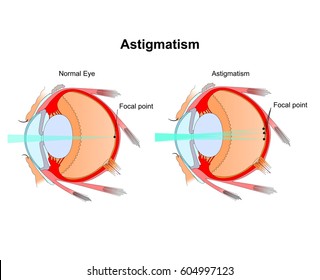 Astigmatism. Eye vision disorder.Diagram of the eye