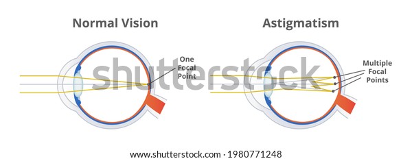 Astigmatism, refractive or refraction error. Eye
disorder, eye does not focus light evenly on the retina. Blurry,
blurred, or distorted vision. The illustration is isolated on a
white background.
