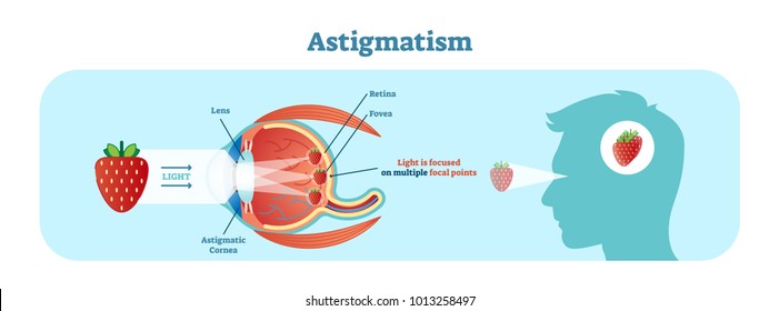 Astigmatism vector illustration diagram, anatomical scheme. Medical educational information. 