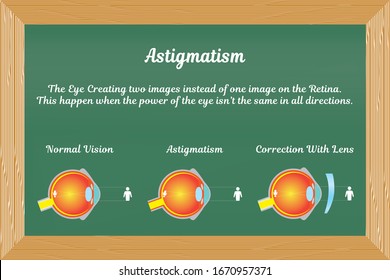 Astigmatism Vision disorders and correction lens, vector on a blue chalkboard.