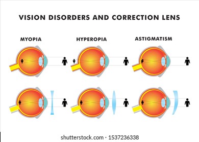 Astigmstism in eye disorders vector illustration