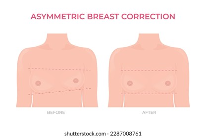 Asymmetric breast correction before and after plastic surgery front view