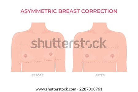 Asymmetric breast correction before and after plastic surgery front view [[stock_photo]] © 