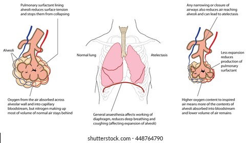 365 Atelectasis Images, Stock Photos & Vectors | Shutterstock