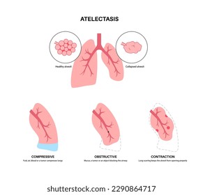 Afiche anatómico de la enfermedad de la telectasis. El colapso total o parcial o el cierre de un pulmón. Cambio reducido o ausente de gas. Pulmones llenos de líquido alveolar. Ilustración vectorial plana del sistema respiratorio