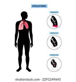 Afiche anatómico de la enfermedad de la telectasis. El colapso total o parcial o el cierre de un pulmón. Cambio reducido o ausente de gas. Pulmones llenos de líquido alveolar. Ilustración vectorial plana del sistema respiratorio