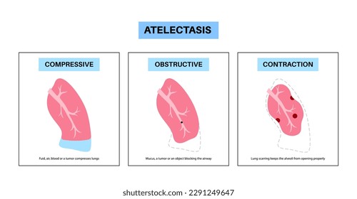 Atelectasis disease anatomical poster. Complete or partial collapse or closure of a lung. Reduced or absent gas exchange. Lungs filled with alveolar fluid. Respiratory system flat vector illustration