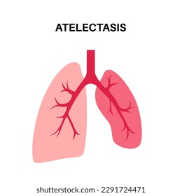 Atelectasis disease anatomical poster. Complete or partial collapse or closure of a lung. Reduced or absent gas exchange. Lungs filled with alveolar fluid. Respiratory system flat vector illustration