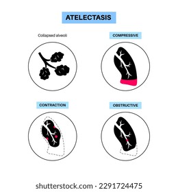 Atelectasis disease anatomical poster. Complete or partial collapse or closure of a lung. Reduced or absent gas exchange. Lungs filled with alveolar fluid. Respiratory system flat vector illustration