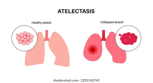 Atelectasis disease anatomical poster. Complete or partial collapse or closure of a lung. Reduced or absent gas exchange. Lungs filled with alveolar fluid. Respiratory system flat vector illustration