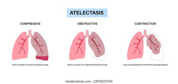 Afiche anatómico de la enfermedad de la telectasis. El colapso total o parcial o el cierre de un pulmón. Cambio reducido o ausente de gas. Pulmones llenos de líquido alveolar. Ilustración vectorial plana del sistema respiratorio