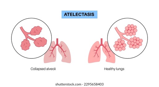 Atelectasis disease anatomical poster. Complete or partial collapse or closure of a lung. Reduced or absent gas exchange. Lungs filled with alveolar fluid. Respiratory system flat vector illustration