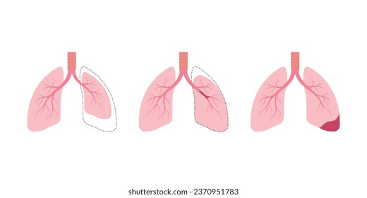 Atelectasis Lung Disease Concept Design. Vector Illustration.