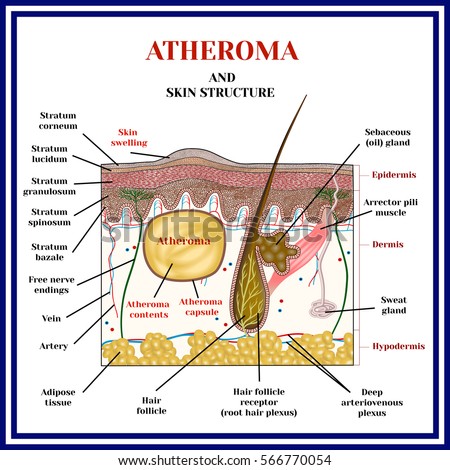 Atheroma Cyst