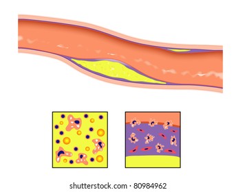Atheroma plaque in artery wall