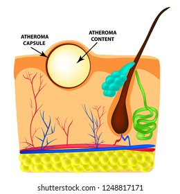 Atheroma structure. The structure of moles on the skin. Infographics. Vector illustration on isolated background. svg