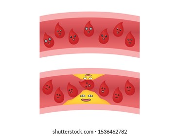Atherosclerosis anime icon vector / fat stuck in the blood artery cholesterol