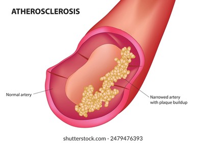 Atherosclerosis of aorta diagram (Atherosclerosis)