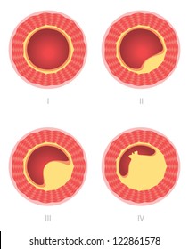 Atherosclerosis Artery Caused By Cholesterol Plaque Stock Vector Royalty Free