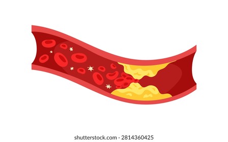 Atherosclerosis. Blocked blood vessel vector illustration. Plaque buildup restricting blood flow. Flat vector for medical, cardiovascular, healthcare, anatomy, disease, education.