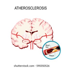 atherosclerosis. Cross section of the brain Human brain