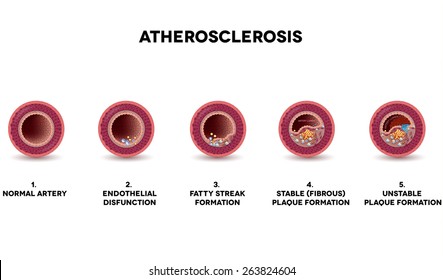 Atherosclerosis formation Healthy artery and unhealthy arteries, showing developing of plaque Detailed illustration of fatty streak formation, white blood cells infiltration, blood clot formation etc.