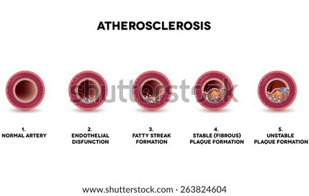 atherosclerosis formation healthy artery unhealthy arteries stock Effects of Atherosclerosis Heart Disease atherosclerosis formation healthy artery and unhealthy arteries, showing developing of plaque detailed illustration of fatty