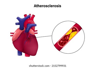 Atherosclerosis With Heart Vector Concept. Coronary Artery Disease. Causes Of Myocardial Ischemia.