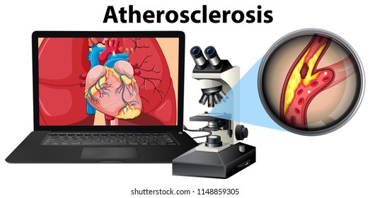 Atherosclerosis laptop and microscope concept illustration