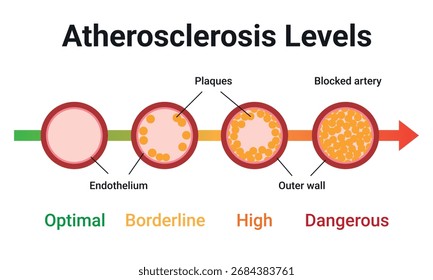 Nível De Aterosclerose. Tipo de colesterol em vasos sanguíneos humanos. Artéria normal, vasculares bloqueadas, manchas gordurosas, placa, moderada. Ilustração do vetor médico.