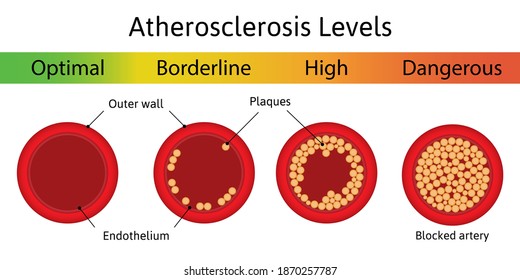 Atherosclerosis levels. Different stages of atherosclerosis arterial disease. Atherosclerotic plaque. Artery anatomy. Medical vector illustration