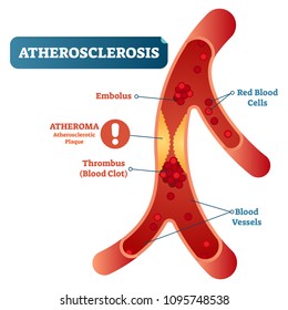 Atherosclerosis Medical Vector Illustration Cross Section Diagram, Unhealthy Blood Vessel Circulatory System Disease. Blocked Blood Flow. Red Blood Cells Thrombus.