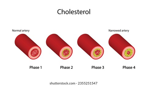 Atherosclerosis, arteria normal versus arteria estrecha bloqueada con placa de colesterol. Bloqueo de un vaso sanguíneo con un coágulo. Alto nivel de colesterol como riesgo aterosclerótico. Ilustración vectorial.