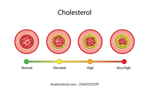 Atherosclerosis, arteria normal versus arteria estrecha bloqueada con placa de colesterol. Bloqueo de un vaso sanguíneo con un coágulo. Alto nivel de colesterol como riesgo aterosclerótico. ldl y hdl. Diseño de vectores