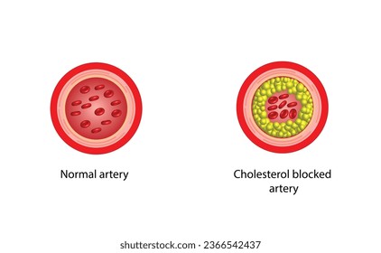 Atherosclerosis, normal artery versus narrowed artery blocked with cholesterol plaque. Blood vessel blocked with a clot. High cholesterol level as atherosclerotic risk. ldl and hdl. Vector design.