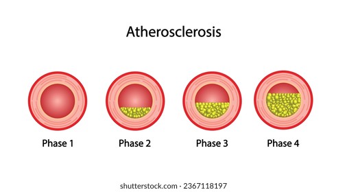 Atherosclerosis, normal artery versus narrowed artery blocked with cholesterol plaque. Blood vessel blocked with a clot. High cholesterol level as atherosclerotic risk. ldl and hdl. Vector design