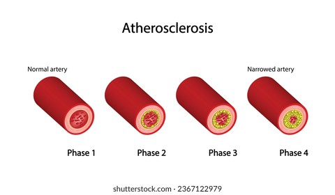 Atherosklerose, normale Arterie versus verengte Arterie, verstopft mit Cholesterin-Plaque. Blutgefäß mit Gerinnsel verstopft. Hoher Cholesterinspiegel als atherosklerotisches Risiko. ldl und hdl. Vektordesign