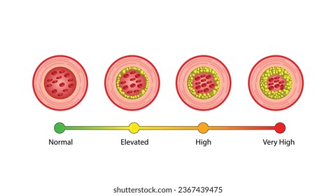 Atherosclerosis, normal artery versus narrowed artery blocked with cholesterol plaque. Blood vessel blocked with a clot. High cholesterol level as atherosclerotic risk. ldl and hdl. Vector design