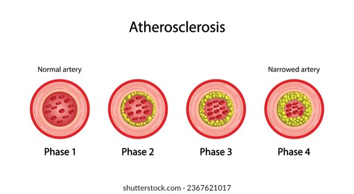 Atherosclerosis, normal artery versus narrowed artery blocked with cholesterol plaque. Blood vessel blocked with a clot. High cholesterol level as atherosclerotic risk. ldl and hdl. Vector design