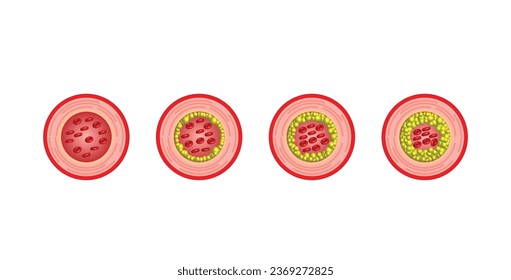 Atherosclerosis, normal artery versus narrowed artery blocked with cholesterol plaque. Blood vessel blocked with a clot. High cholesterol level as atherosclerotic risk. ldl and hdl. Vector design