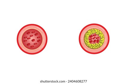Atherosklerose, normale Arterie versus verengte Arterie, verstopft mit Cholesterin-Plaque. Blutgefäß mit Gerinnsel verstopft. Hoher Cholesterinspiegel als atherosklerotisches Risiko. Vektorgrafik.