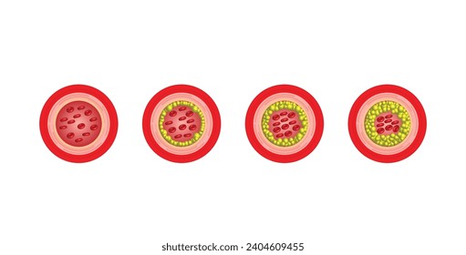 Atherosclerosis, arteria normal versus arteria estrecha bloqueada con placa de colesterol. Bloqueo de un vaso sanguíneo con un coágulo. Alto nivel de colesterol como riesgo aterosclerótico. Ilustración vectorial.