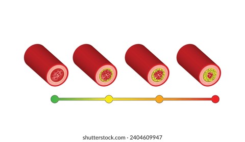 Atherosclerosis, arteria normal versus arteria estrecha bloqueada con placa de colesterol. Bloqueo de un vaso sanguíneo con un coágulo. Alto nivel de colesterol como riesgo aterosclerótico. Ilustración vectorial.