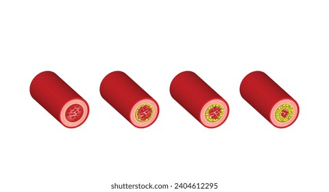 Atherosclerosis, normal artery versus narrowed artery blocked with cholesterol plaque. Blood vessel blocked with a clot. High cholesterol level as atherosclerotic risk. ldl and hdl. Vector design.