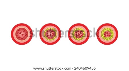 Atherosclerosis, normal artery versus narrowed artery blocked with cholesterol plaque. Blood vessel blocked with a clot. High cholesterol level as atherosclerotic risk. Vector illustration.