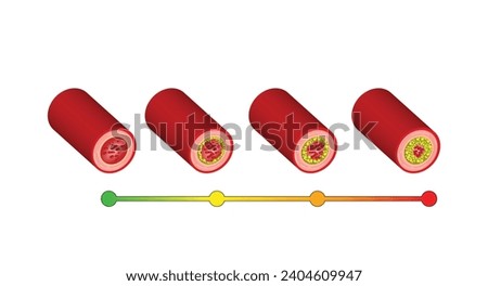 Atherosclerosis, normal artery versus narrowed artery blocked with cholesterol plaque. Blood vessel blocked with a clot. High cholesterol level as atherosclerotic risk. Vector illustration.