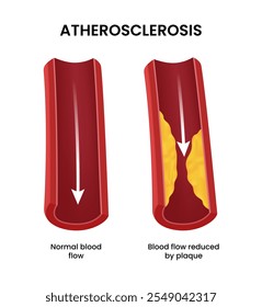 Atherosklerose von normalem Blut und Blutfluss reduziert durch Plaque